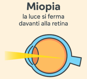 Illustrazione educativa in stile cartoon che mostra un occhio con raggi luminosi che si focalizzano davanti alla retina, rappresentando la miopia.